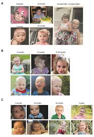 Scielo Brasil Development Of A Clinical Algorithm For The Early Diagnosis Of Mucopolysaccharidosis Iii Development Of A Clinical Algorithm For The Early Diagnosis Of Mucopolysaccharidosis Iii