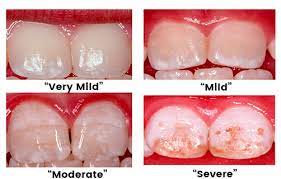 Dental Fluorosis Treatment Micro Abrasion Tooth Bleaching Bangalore