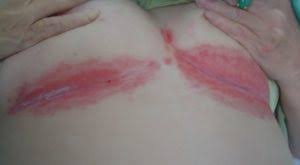 Image result for heat rash under breasts