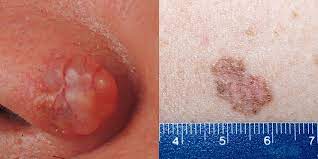 There are a number of different treatments doctors recommend. 7 Skin Cancer Symptoms Besides New Moles Signs Of Skin Cancer