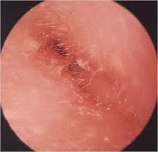 Image result for Acute Otitis Externa