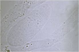 Image result for Urinary Cast