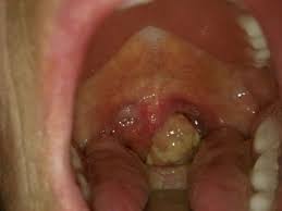 Doctors do biopsies to diagnose mouth and throat cancers. Throat Cancer Pictures Survival Rate Symptoms Causes Treatment Hubpages