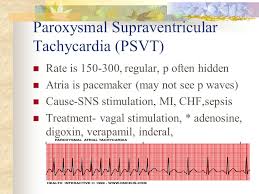 Paroxysmal supraventricular tachycardia (psvt) is a type of arrhythmia arising from a defect in atrioventricular conduction, which causes the heart to sporadically beat faster. Arrhythmias By Nancy Jenkins Ppt Video Online Download