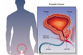 Like many diseases, it's likely some combination of environmental and genetic factors. Prostate Cancer Mate Pukupuku Repe Tatea Health Navigator Nz