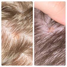 How to check yourself for skin cancer. Is This Skin Cancer Left Is Myself Right Is Bf I Have A Few More On My Scalp Dermatologyquestions