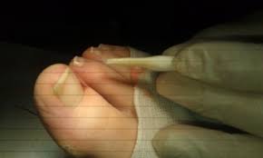 Image result for Akutní zánět nehtového lůžka