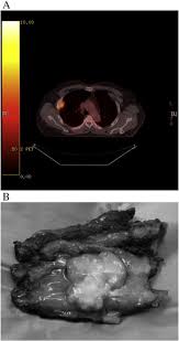 Other mesothelioma symptoms of peritoneal mesothelioma may include bowel obstruction, blood clotting abnormalities, lowered red blood cell count, and high fever. Pet Ct In The Diagnosis Of Localized Malignant Pleural Mesothelioma Sciencedirect