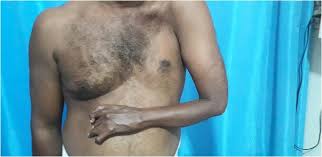 The shoulder, arm, and hand also can be involved. A Case Of Unilateral Amazia Chest Alopecia And Hand Anomaly Springerlink