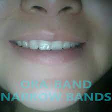 I closed the gap in my front teeth at home with those clear plastic rubber bands that cost less than $5! Boj Nafukovat Komercni Front Teeth Gap Band Dva Stupne Sbirka Vystredni