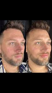 Cheeks and lips 💋 for the PERFECT volume! , Love these results so much! I  get so excited when I look through the camera roll and see before and after  photos like this because I know the confidence ...