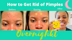Maybe you would like to learn more about one of these? Starface Pimple Patch Review 2020 How To Get Rid Of Pimples Overnight Glow Star Refill Youtube