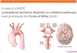 This part of the brain was first discovered by the english doctor thomas willis in the 17th century. A Functional Assessment Of The Circle Of Willis Before Aortic Arch Surgery Using Transcranial Doppler The Journal Of Thoracic And Cardiovascular Surgery