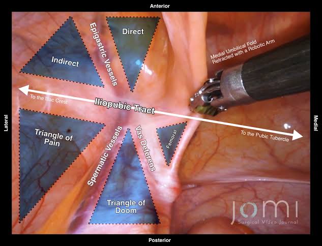 Anatomía Preperitoneal En Tep: Identificación De Zonas De Seguridad Y Riesgo, Generada Por Ia