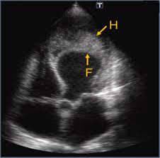 Intramyocardial Dissecting Hematoma: A Mechanical Complication Needing  Surgical Therapy? | JACC: Case Reports