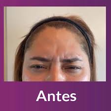 ¡Aplicación de botox! , Elimina esas arrugas y líneas de expresión que no  quieres 🙅🏻‍♀️, Pregunta por nuestras sesiones. , #botox #aplicación  #medicinaestetica #piel #skinlove #beautytreatment #health ...