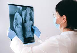 What causes stage iv lung cancer? 10 Signs You May Have Lung Cancer Rediff Com Get Ahead