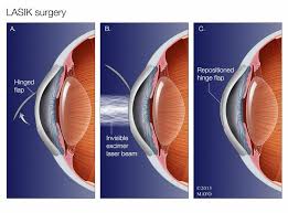 Mayo Clinic Q And A Thorough Evaluation Before Lasik Surgery Can Help Avoid Problems Lasik Surgery Eye Surgery Lasik