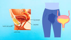 Image result for Urinary Incontinence