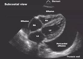 Alterações do st na cardiopatia isquêmica. Pericardite Aguda Conceito Tipos Diagnosticos E Tratamento Medway