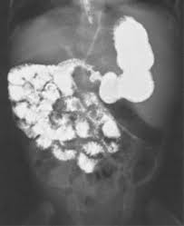 Image result for Midgut Volvulus