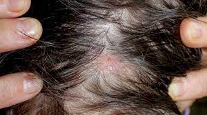 Hair Loss (Alopecia): Causes, Symptoms, And Regrowth Options