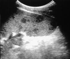 Image result for Splenic Abscess