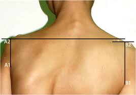 Stretch your upper trapezius because tightness in this muscle contributes to uneven shoulder blades, you'll want to. Shoulder Imbalance Treated With Scapuloplasty Surgery In Scoliosis Patients A Clinical Retrospective Study Journal Of Orthopaedic Surgery And Research Full Text