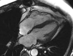 Myocarditis can affect your heart severe myocarditis weakens your heart so that the rest of your body doesn't get enough blood. Novel Cardiac Mri Protocol Explores Impact Of Covid 19linked Myocardial Injury University Hospitals