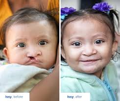 This #WorldSmileDay tune in to watch the story of a young man named Enok,  who never knew the joy of sharing his smile. He lived in hiding for 25  years because people