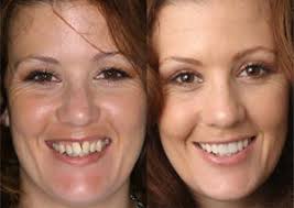 No Mock Up Done For Veneers Temporary Veneers Look Terrible Can I Make Changes To Permanent Veneers Beautiful Teeth Dentist Dental Exam