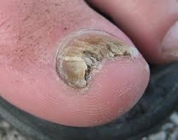 No vicks is no good in my case as i had severe loss of toenails. What Does Toenail Fungus Look Like Toenail Fungus Pictures