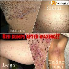 Ever Got Painful Itchy Red Bumps Or Ingrown Hairs After Waxing Waxing Shaving Threading Cause Trauma To Hair Shaft Inside Your Skin Few Of Them Curls Inside The Skin And Fails To Come Out Causing
