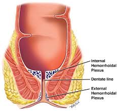 Image result for Hemorrhoid