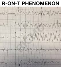 Image result for Extrasystole