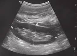 El ultrasonido de la pelvis utiliza ondas sonoras para producir imágenes de las estructuras y órganos de la parte inferior del abdomen y la pelvis. Ultrasonido Renal Que Muestra El Tamano Y La Relacion Entre La Corteza Download Scientific Diagram