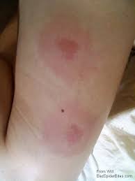 Bug Bite Black And Blue Ring Insect Bites Id Help