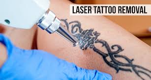 Please select a treatment area from the list below to compare the average cost of treatment in key countries. Tattoo Removal Treatment In Hyderabad Using Advanced Laser Tech