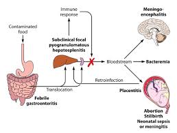 Muscle aches and pains are common symptoms of listeriosis and typically last anywhere between one and three days. Transmission Of And Infection With Listeria About Listeria
