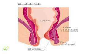 Hamorrhoiden Symptome Behandlung Vorbeugen Onmeda De
