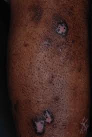 Dermnet.com › browse categories › psoriasis pictures, lichen planus and related diseases › lichen planus hypertrophic (page 1) lichen planus hypertrophic photos. Lichen Planus Dermatology Advisor