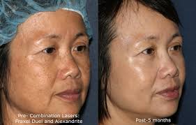 Thus heating up the follicle and disabling the hair growth mechanism. Asian Skin Dermatology Experts San Diego Ca Clderm
