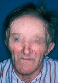 Enfermedad ósea de Paget