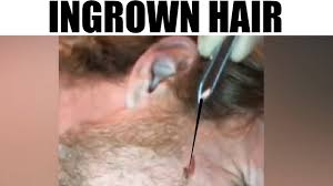 The guinness world records released its 2018 book thursday complete with bizarre and inspiring record holders. World S Longest Ingrown Hair Biggest Cysts Blackest Blackheads Youtube