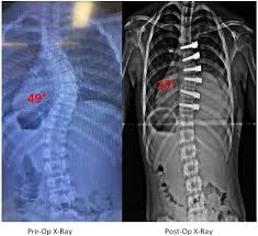 Myas X Rays Scoliosis Surgery Scoliosis Surgery