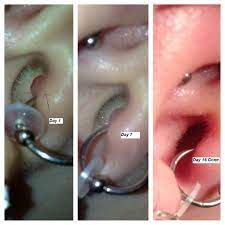 In This Instance The Disc Has Been Moved Away From The Area So We Can See The Results After A Few Short We Acne On Nose Nose Piercing Daith Piercing Infection