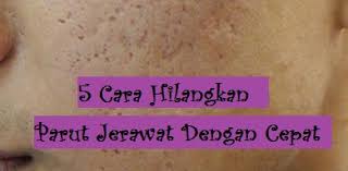 Apr 27, 2021 · january 26, 2021 aku yang tidak kau ini itu dan di anda akan apa dia saya kita untuk mereka ada tahu dengan bisa dari tak kamu kami adalah ke ya orang tapi harus pergi baik dalam sini seperti hanya ingin sekarang semua saja sudah jika oh apakah jadi satu jangan notes 1) this list was created using public/free 5 Cara Hilangkan Parut Jerawat Dengan Cepat I Am Zuraida