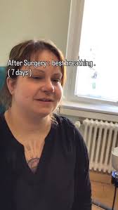 Erste Atmung nach Splints Entfernung . #berlin #اكسبلور_فولو #hno  #explorepage #nasenkorrektur