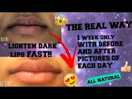The Real Way To Lighten Dark Lips Fast W Before And After Pictures Dark Lips Lip Lightening Skin Brightening