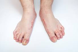 In most settings, hand washing with soap and water is generally preferred. Cure Your Athlete S Foot With Time Honored Remedies The People S Pharmacy